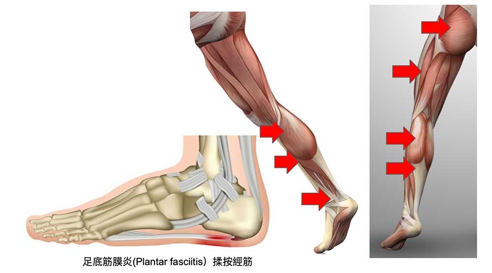 改善足底筋膜炎可以從經筋肌肉下手