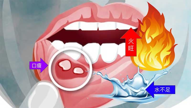 口乾舌燥、口舌生瘡經常是體內火旺水不足所造成