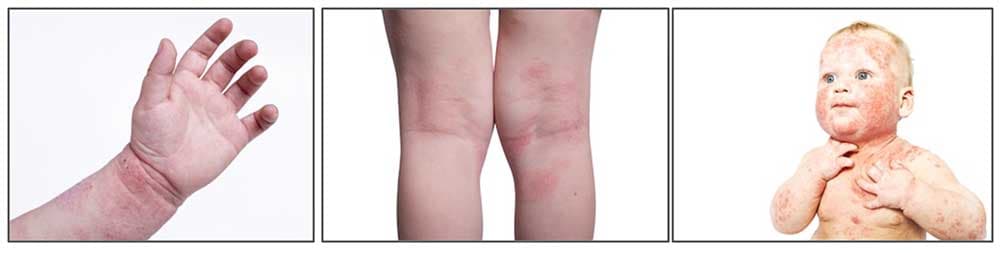 異位性皮膚炎經常發生於小兒身上