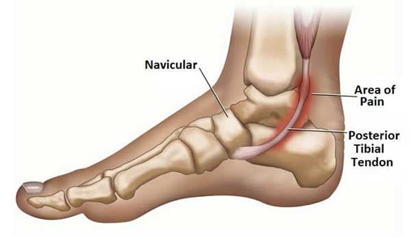 腳內側痛多數的時候稱之為脛後肌肌腱功能不全
