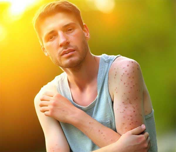 夏季濕熱容易出現各種皮膚病
